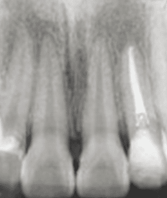 치아 주위 조직의 회복