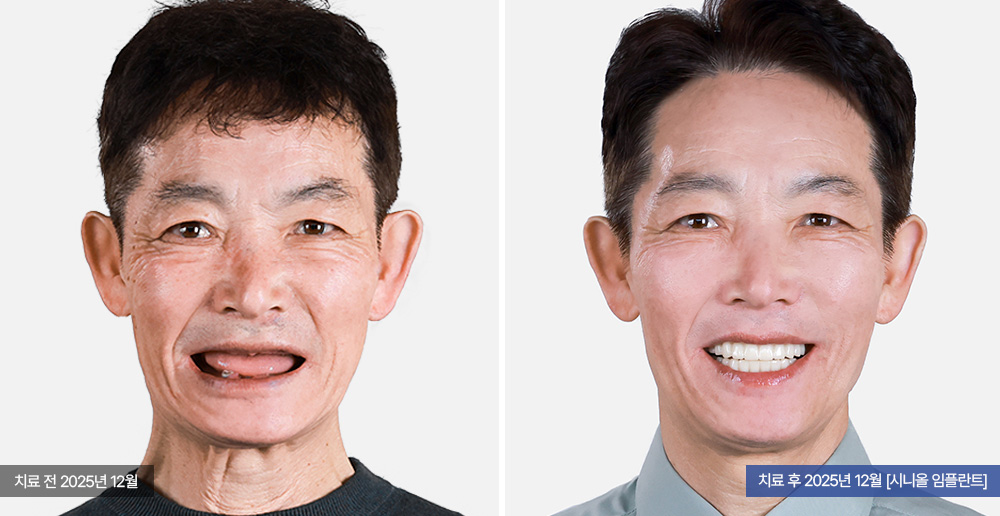 임플란트 사례 사진