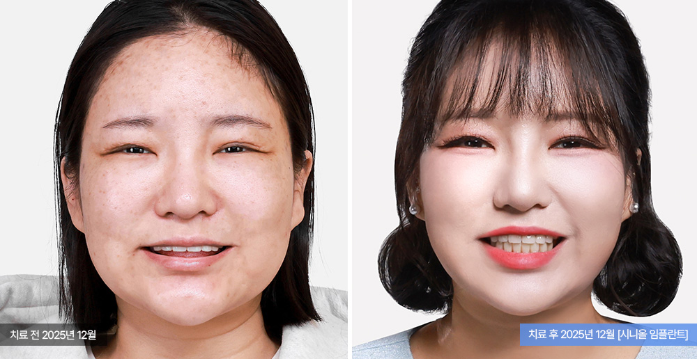 임플란트 사례 사진