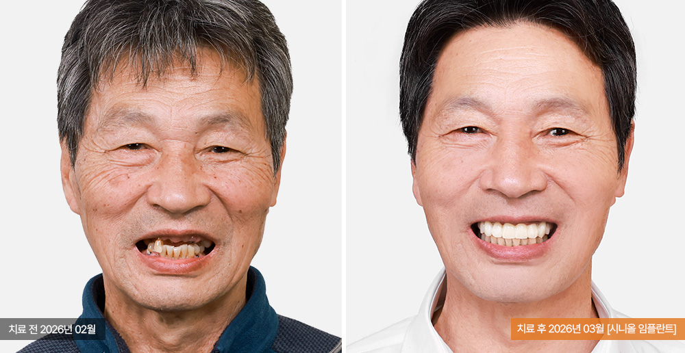 임플란트 사례 사진