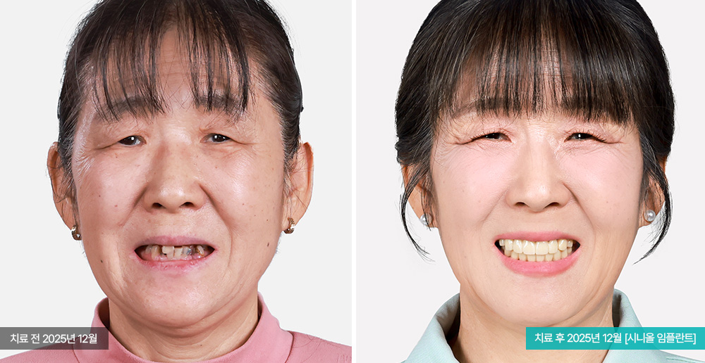 임플란트 사례 사진