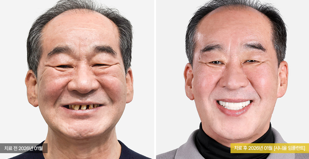 임플란트 사례 사진