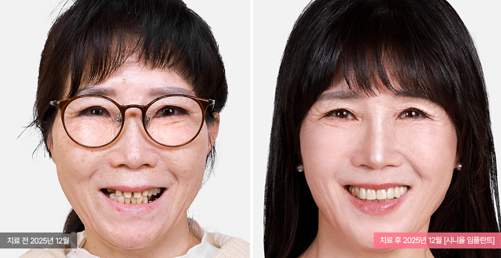 임플란트 사례 사진
