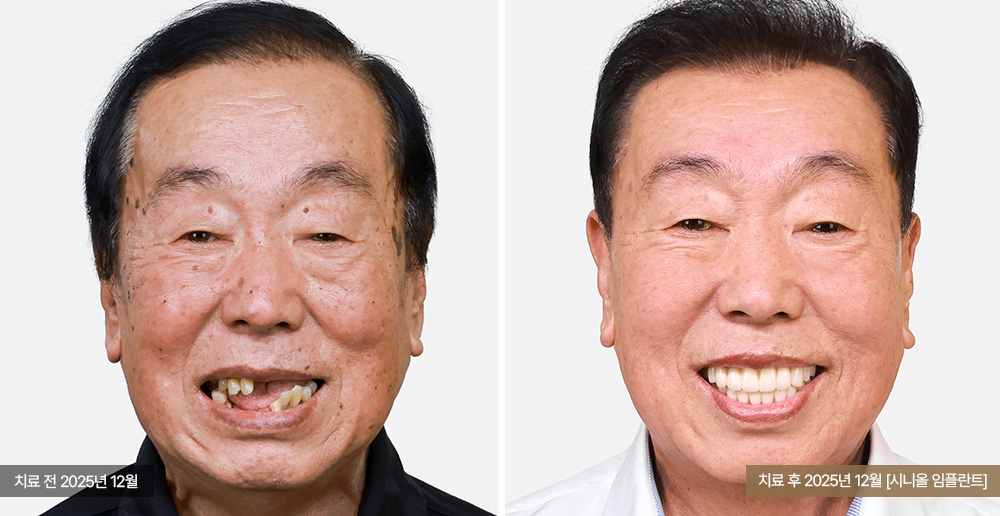 임플란트 사례 사진