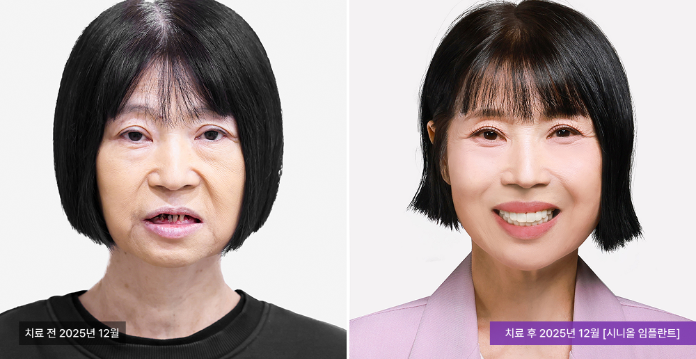 임플란트 사례 사진