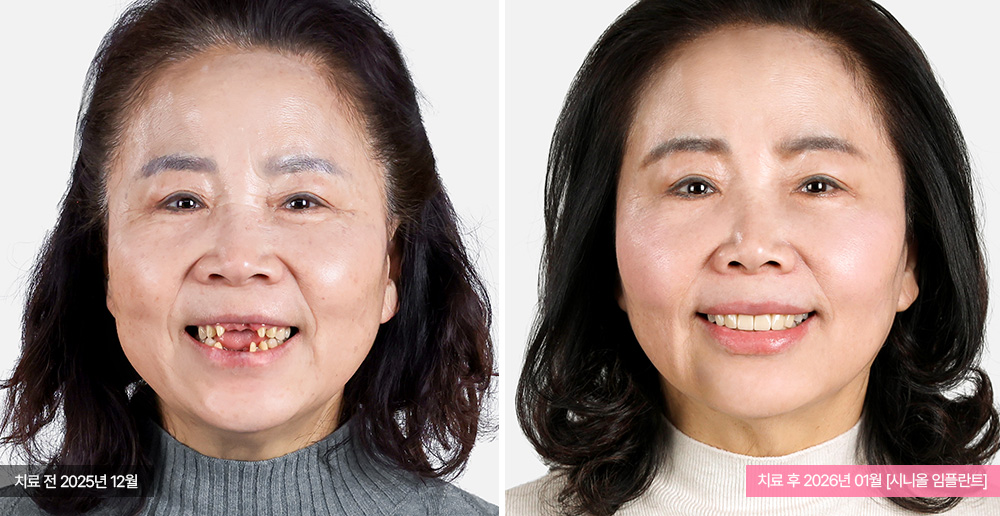 임플란트 사례 사진